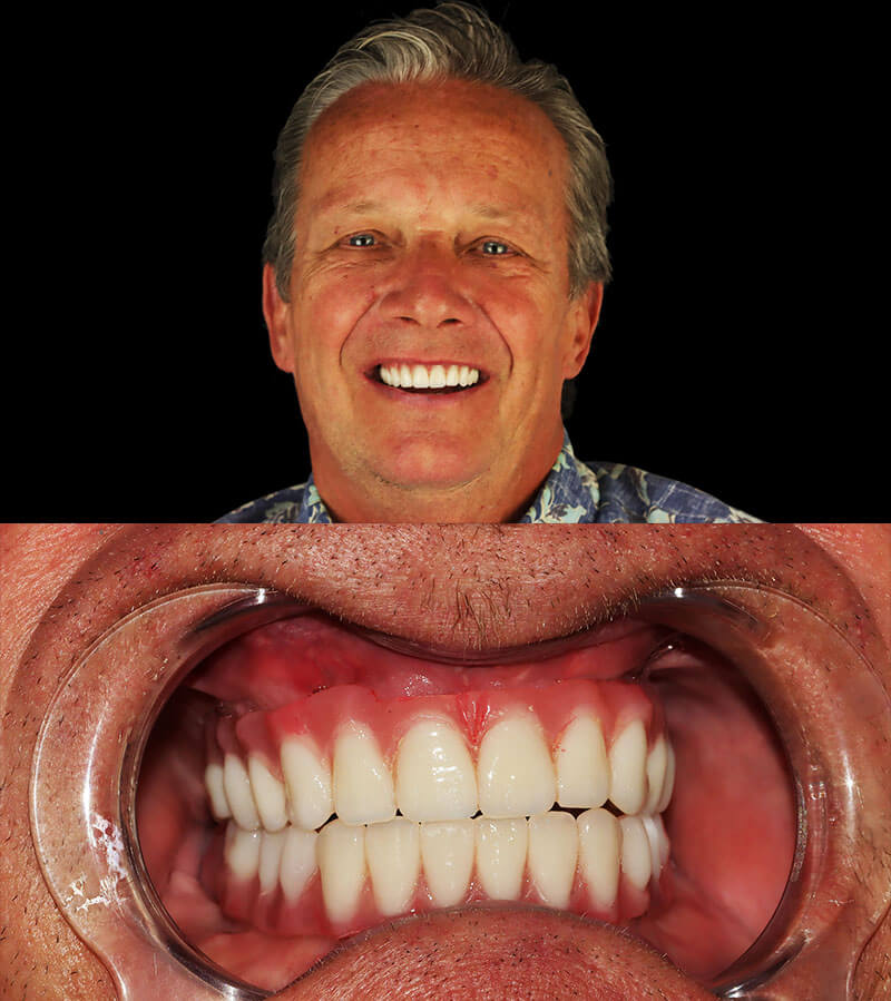 old man with full mouth reconstruction smiling
