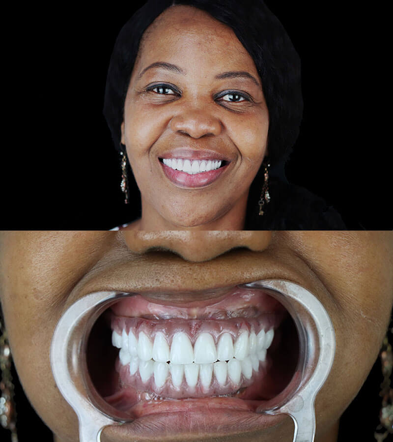 patient with full mouth dental implant restoration