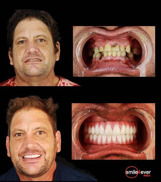 all on 4 dental implants before after