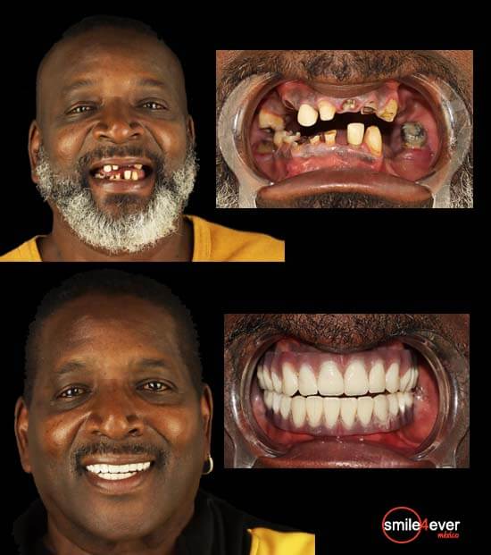 smile 4 ever mexico´s men patient before and after pictures of her treatment with 3 on 6 dental implants