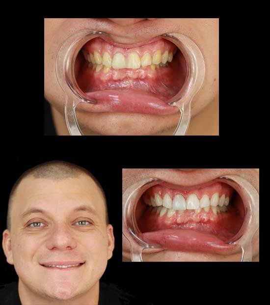 cosmetic dentist in mexico change live of patient with dental crowns