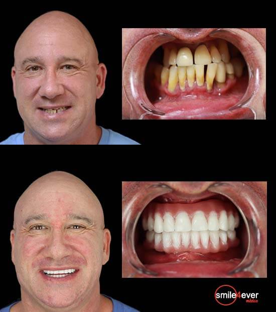 smile 4 ever mexico´s patient picture before his all on 4 fixed hybrid denture