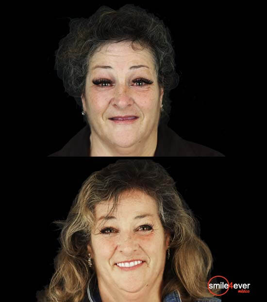 real patient before and after dental implants
