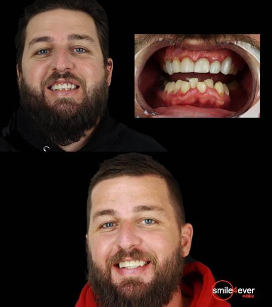 dental implants in mexico before after