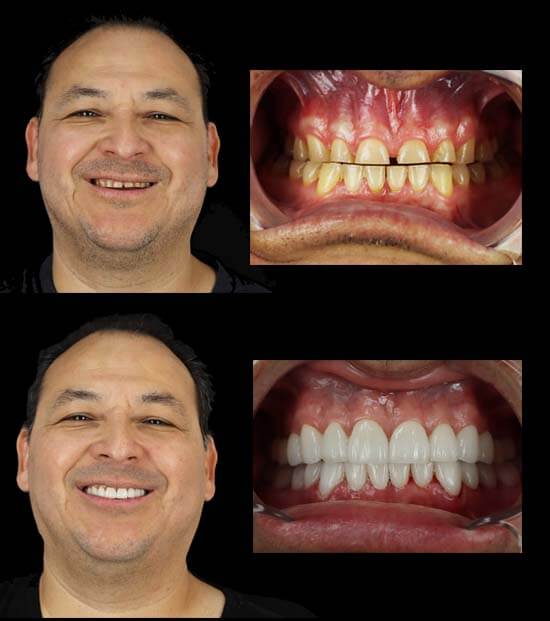 patient with best dental work in mexico before after