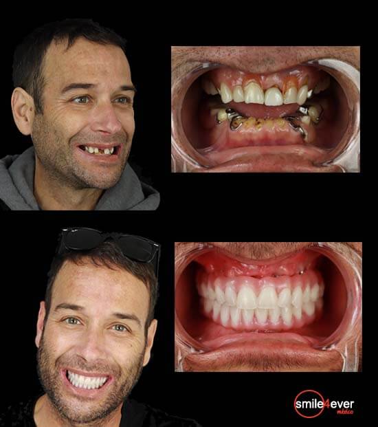 dental work in mexico