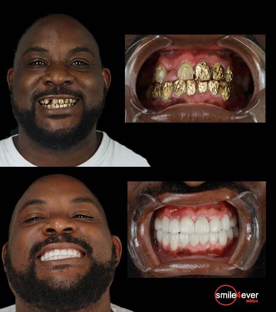 full mouth reconstruction at tijuana dentist