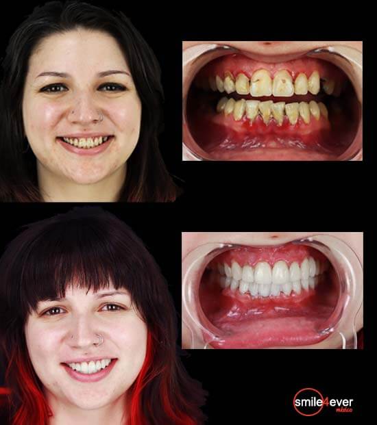 patient with full mouth restoration before after