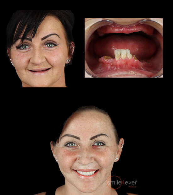 smile 4 ever mexico´s patient before and after pictures of his treatment with dental implants