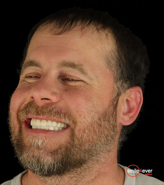Veneers cost full set tijuana