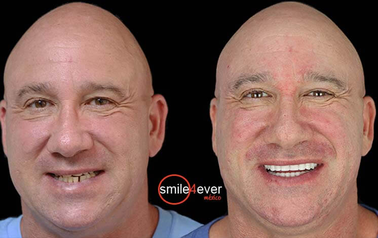 patient before after dentists in Tijuana