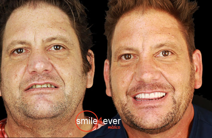 dentists in mexico before after