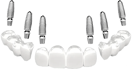 3 on 6 dental implants