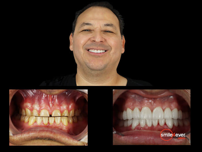 patient before after dental work in mexico