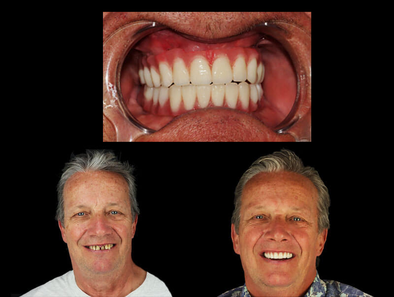 advantages of the dental implant