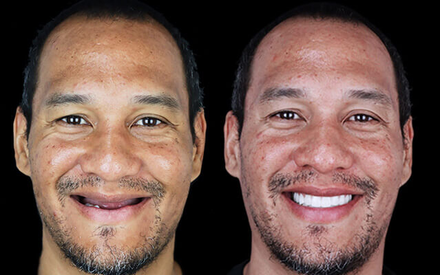 all on 6 dental implants before after