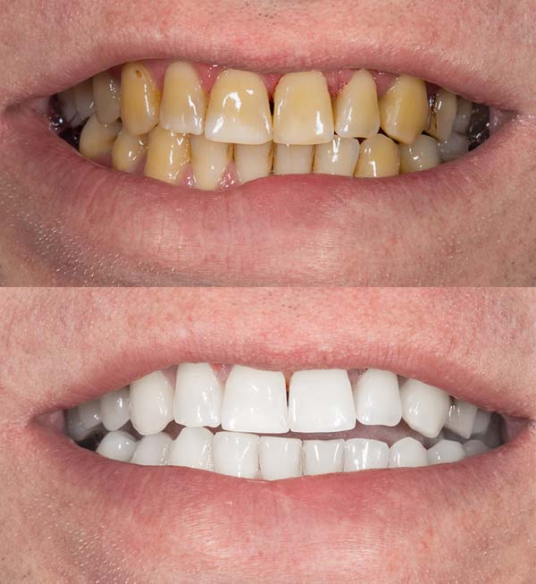 patient with dental crowns in Mexico