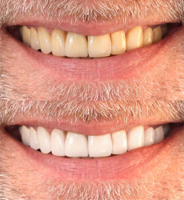 patient with dental crowns in Mexico