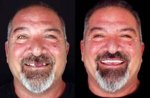 all on 4 implants tijuana patient before after result