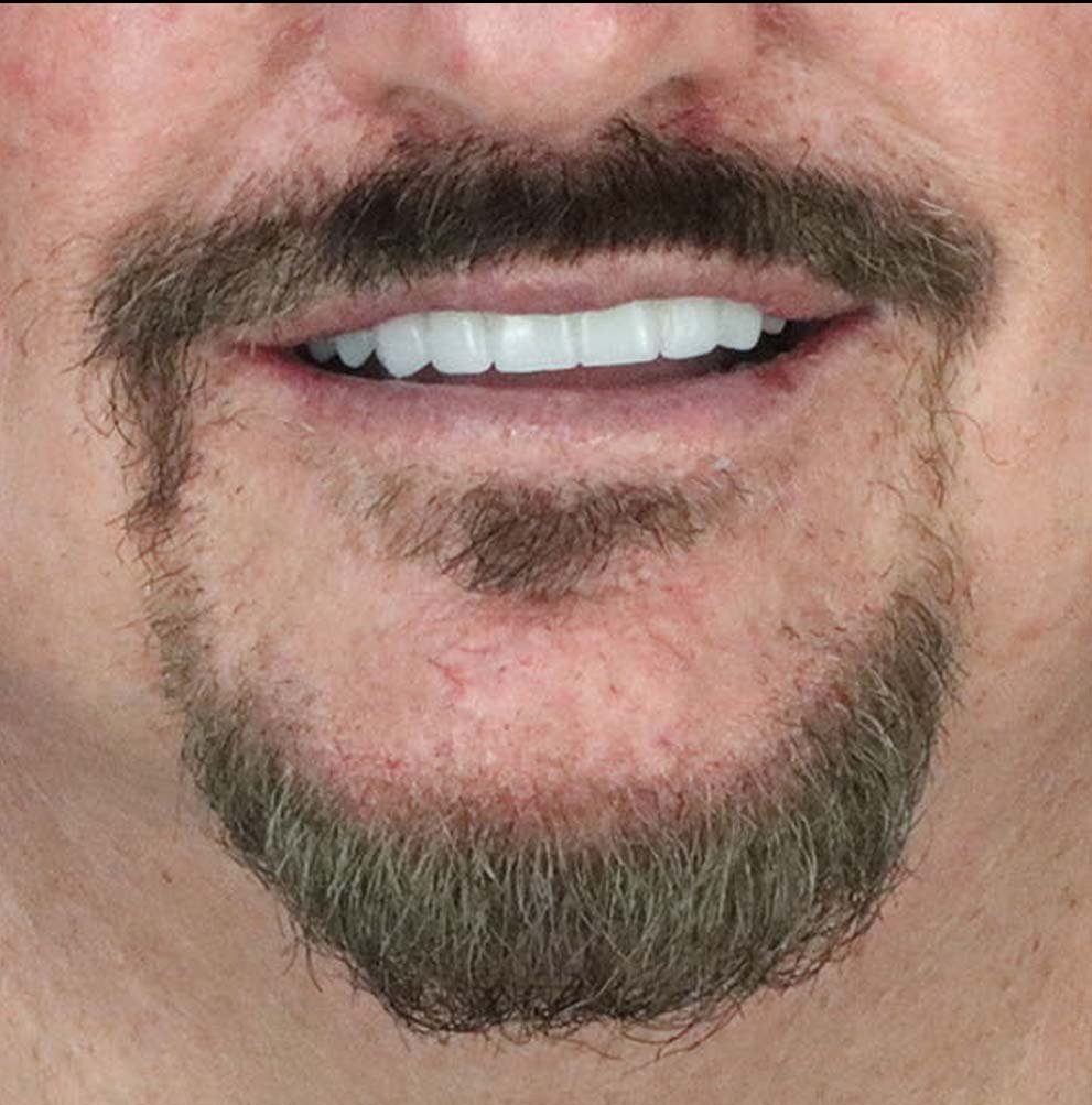 patient case after dental bridge in tijuana