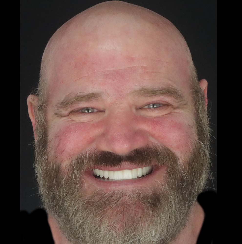 after full mouth reconstruction