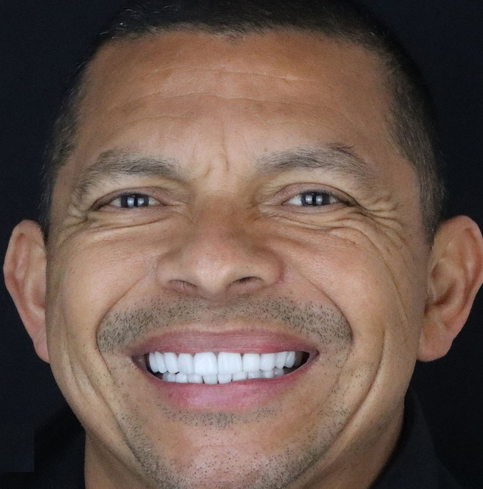 after dental veneers