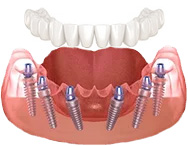 all on 6 dental implants