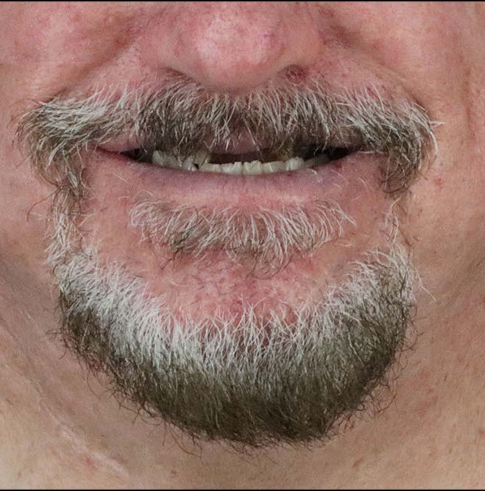 patient case before dental bridge in tijuana