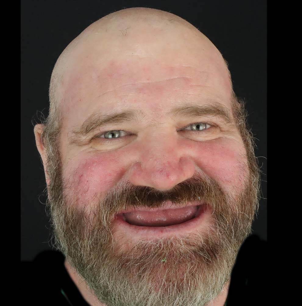 before full mouth reconstruction