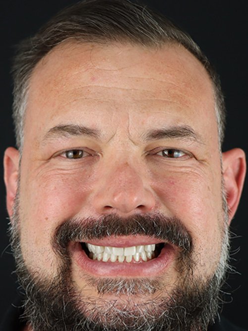 dental crowns in tijuana from smile4evermexico.com