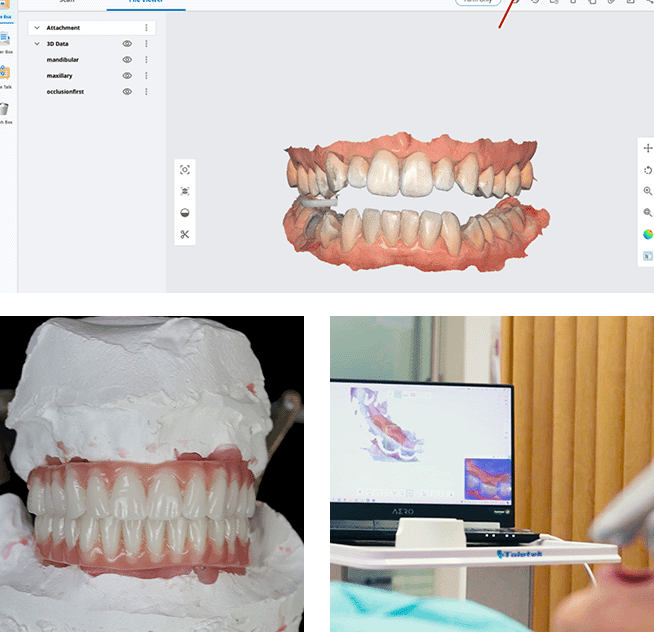 digital snap on dentures