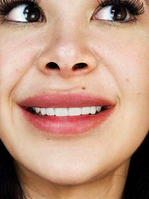 veneers in mexico from smile4evermexico.com