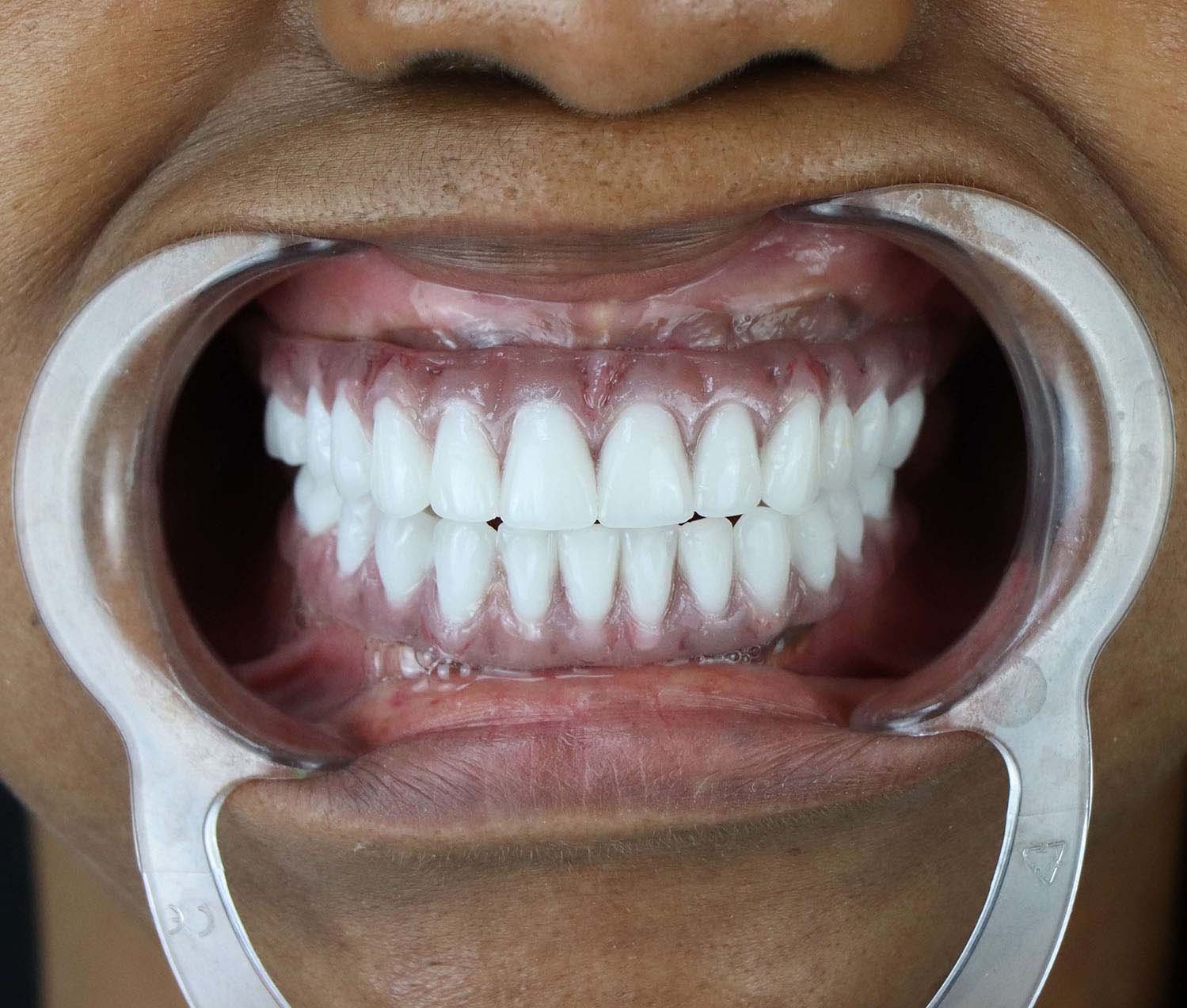 after all on 4 dental implants