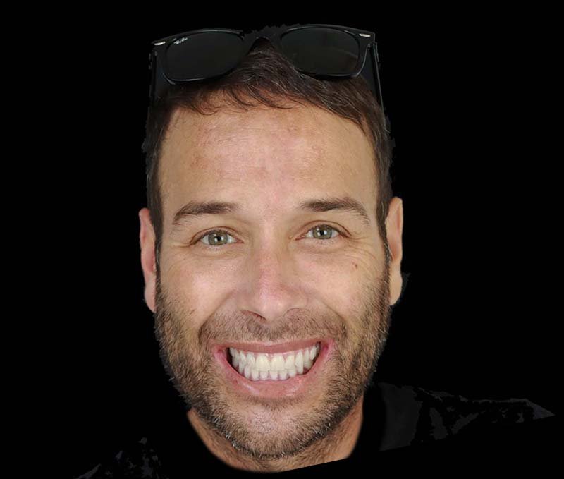 after all on x dental implants in tijuana