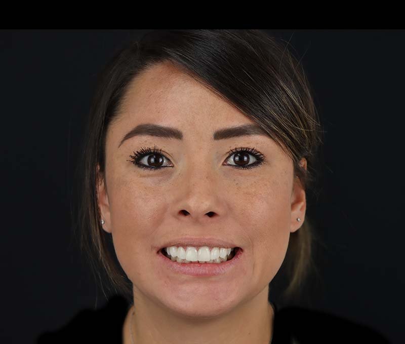 after composite veneers