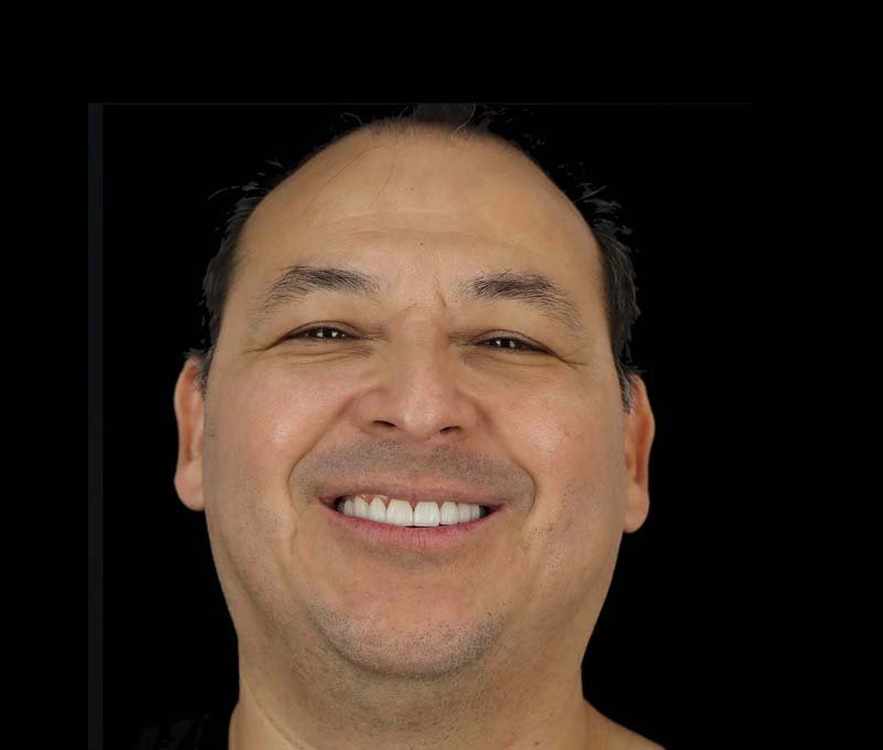 before dental crowns in mexico