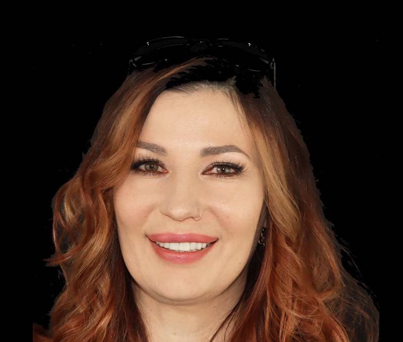 before veneers in mexico