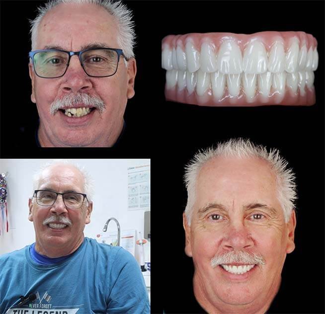 all on 6 dental implants in tijuana from smile4evermexico.com