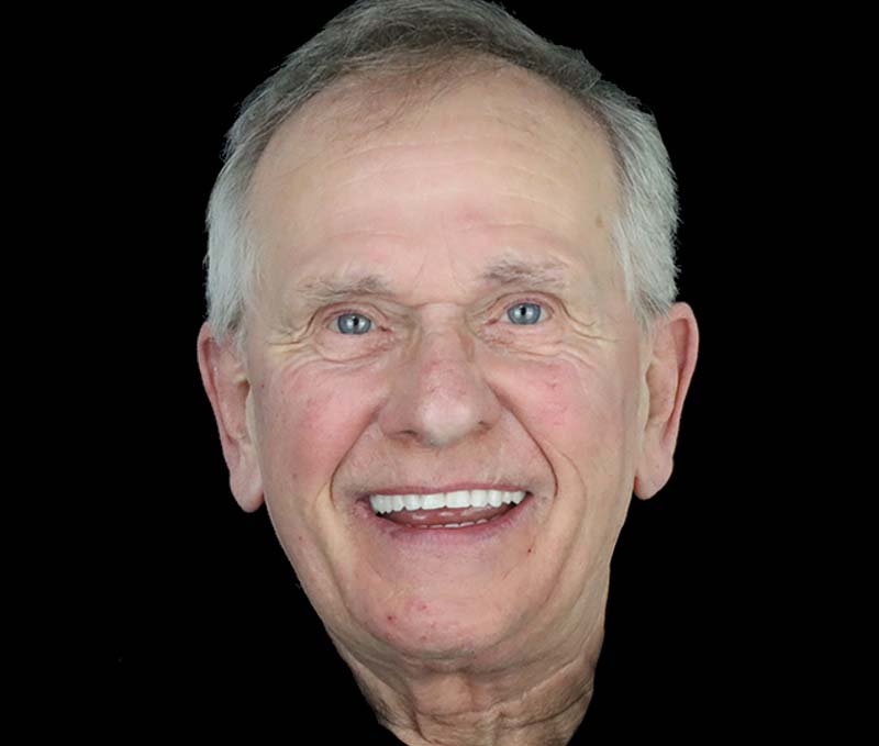 Patient after All-on-X dental implant treatment, showing a natural-looking full smile restored with fixed full-arch dental implants.