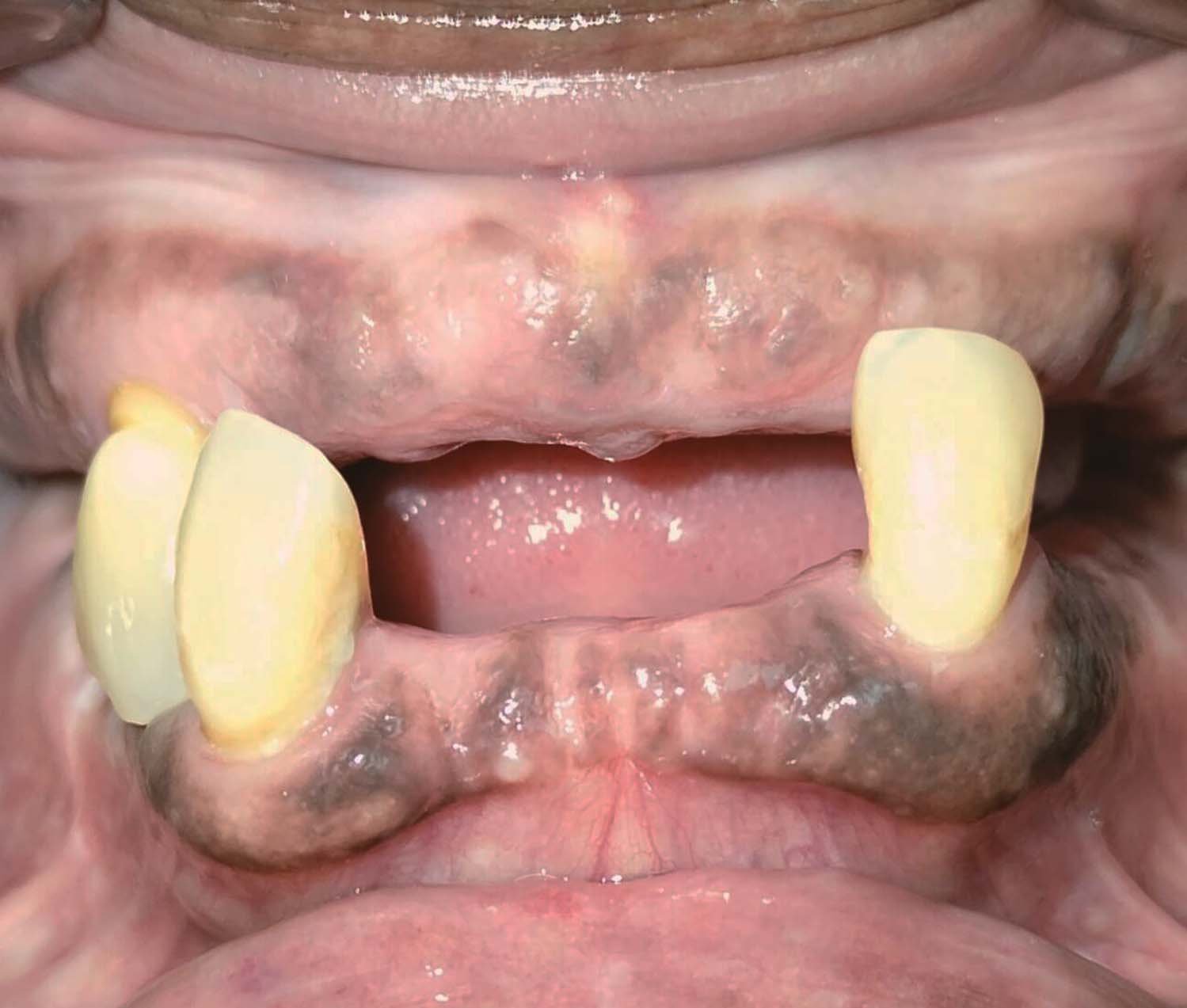 before all on 4 dental implants