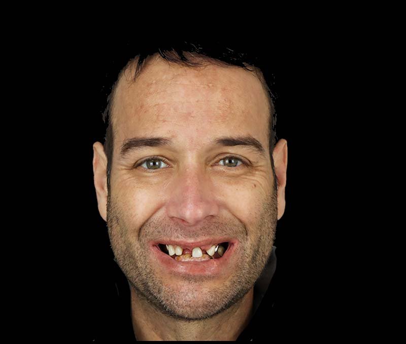 before all on x dental implants in tijuana