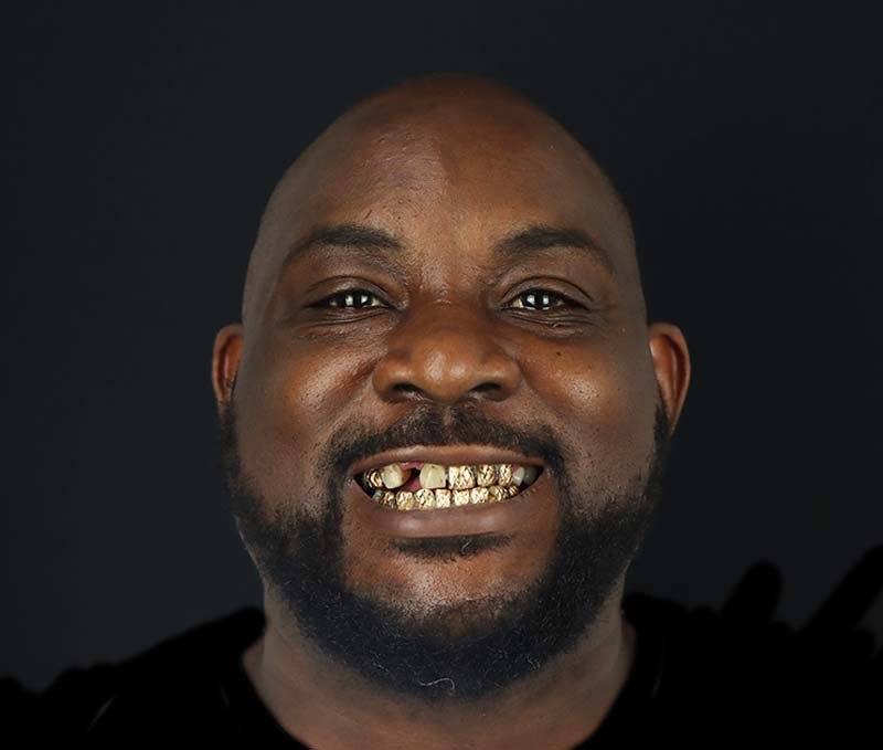 before dental crowns patient sebastian