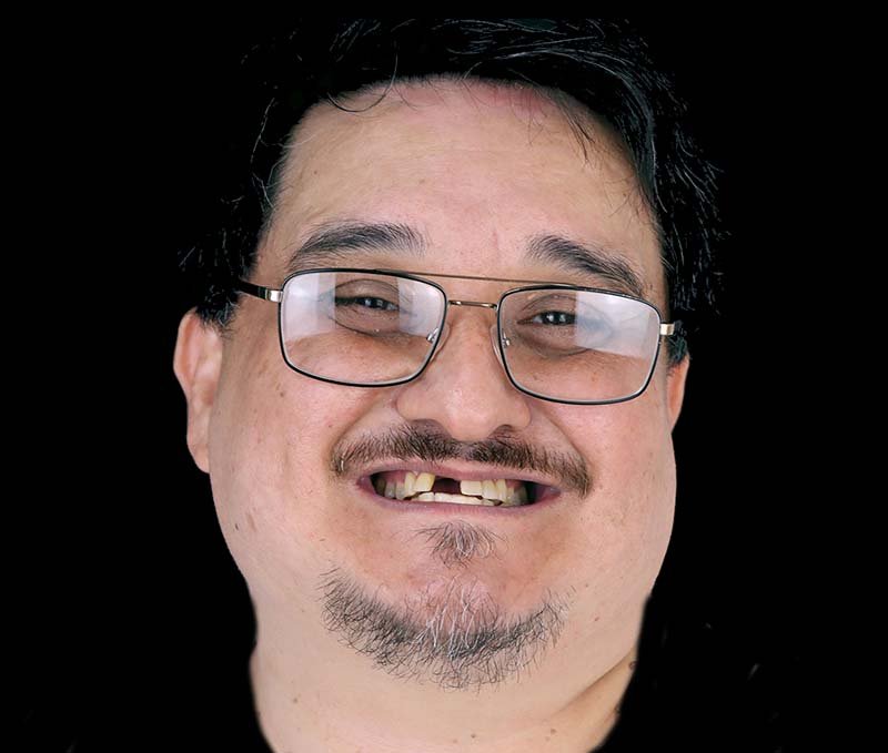 before full dental implants