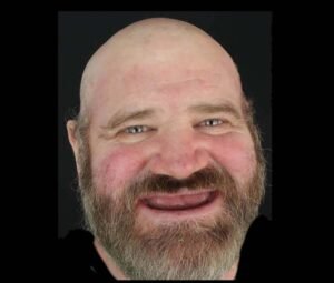 after full mouth dental implants