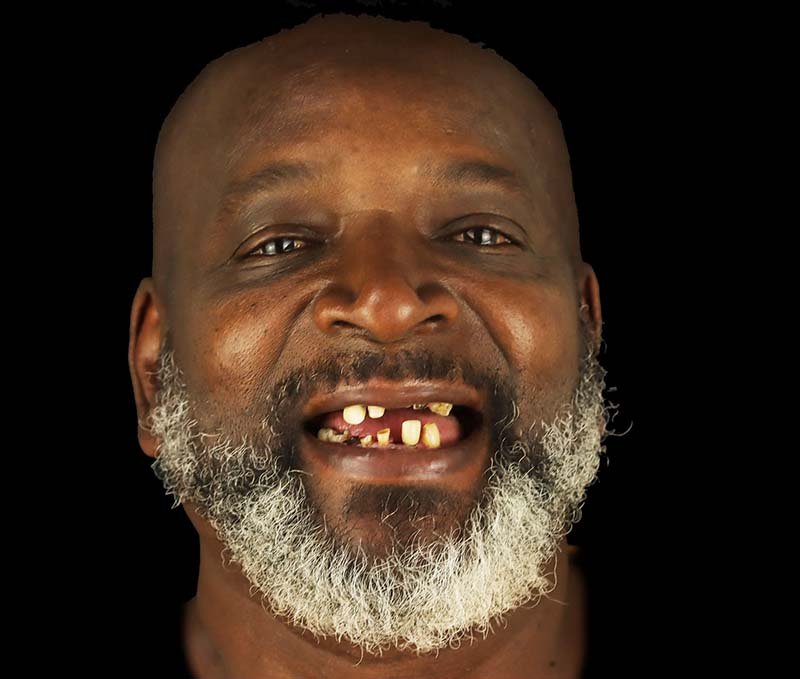 patient with full dental implants before