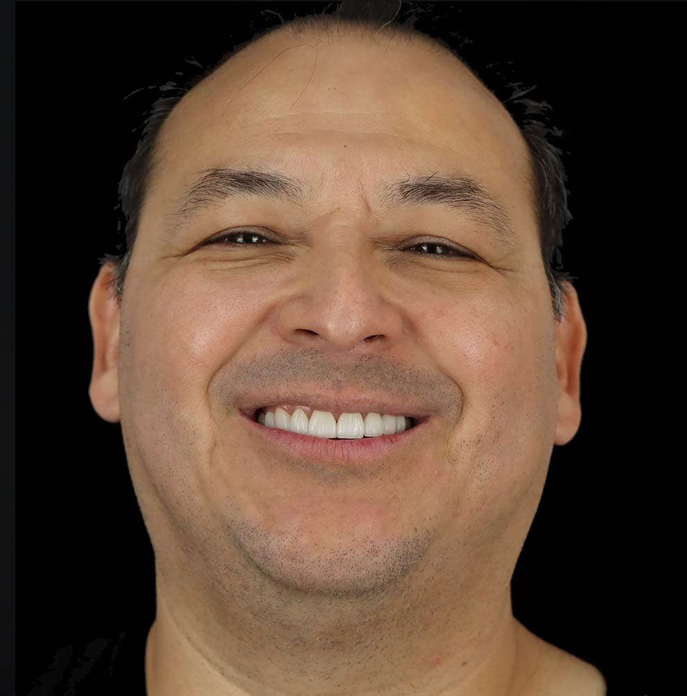 smile makeover in tijuana after case