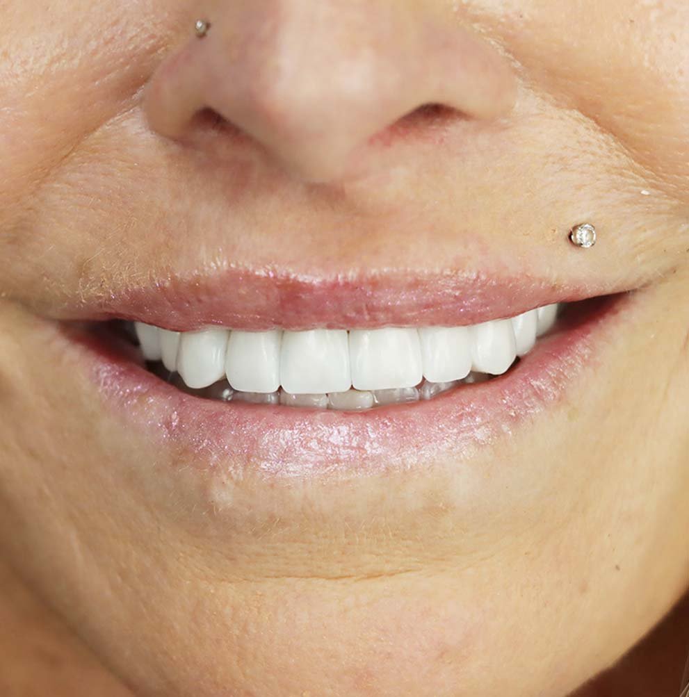 tijuana dental tourism from smile4evermexico.com