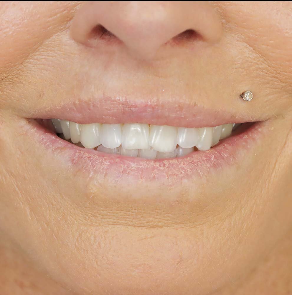 before dental veneers