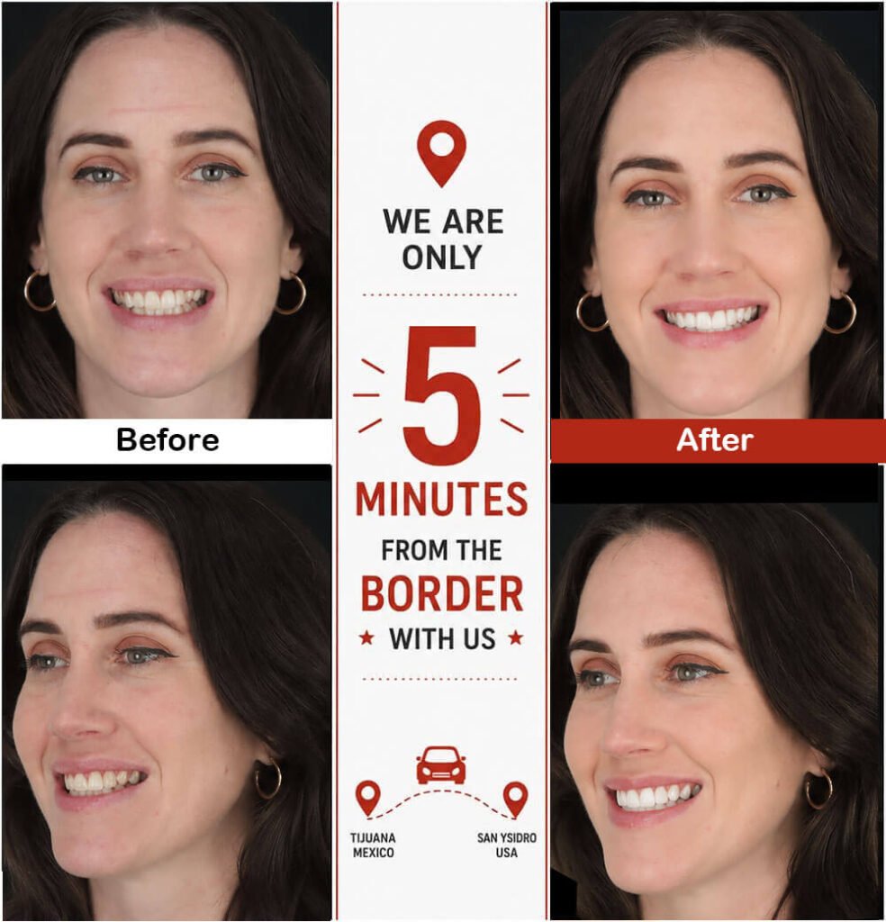 Patient smiling after professional dental cleaning and teeth whitening at Smile4Ever Mexico in Tijuana.