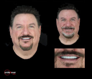 full mouth dental implants in mexico